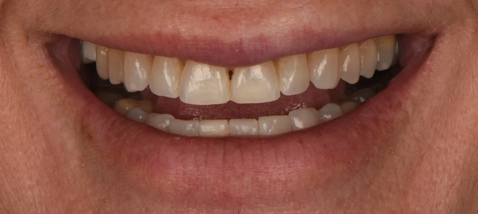 Antes: rehabilitación oral, caso real